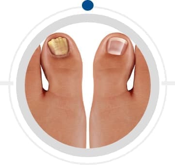reconstruction toenail