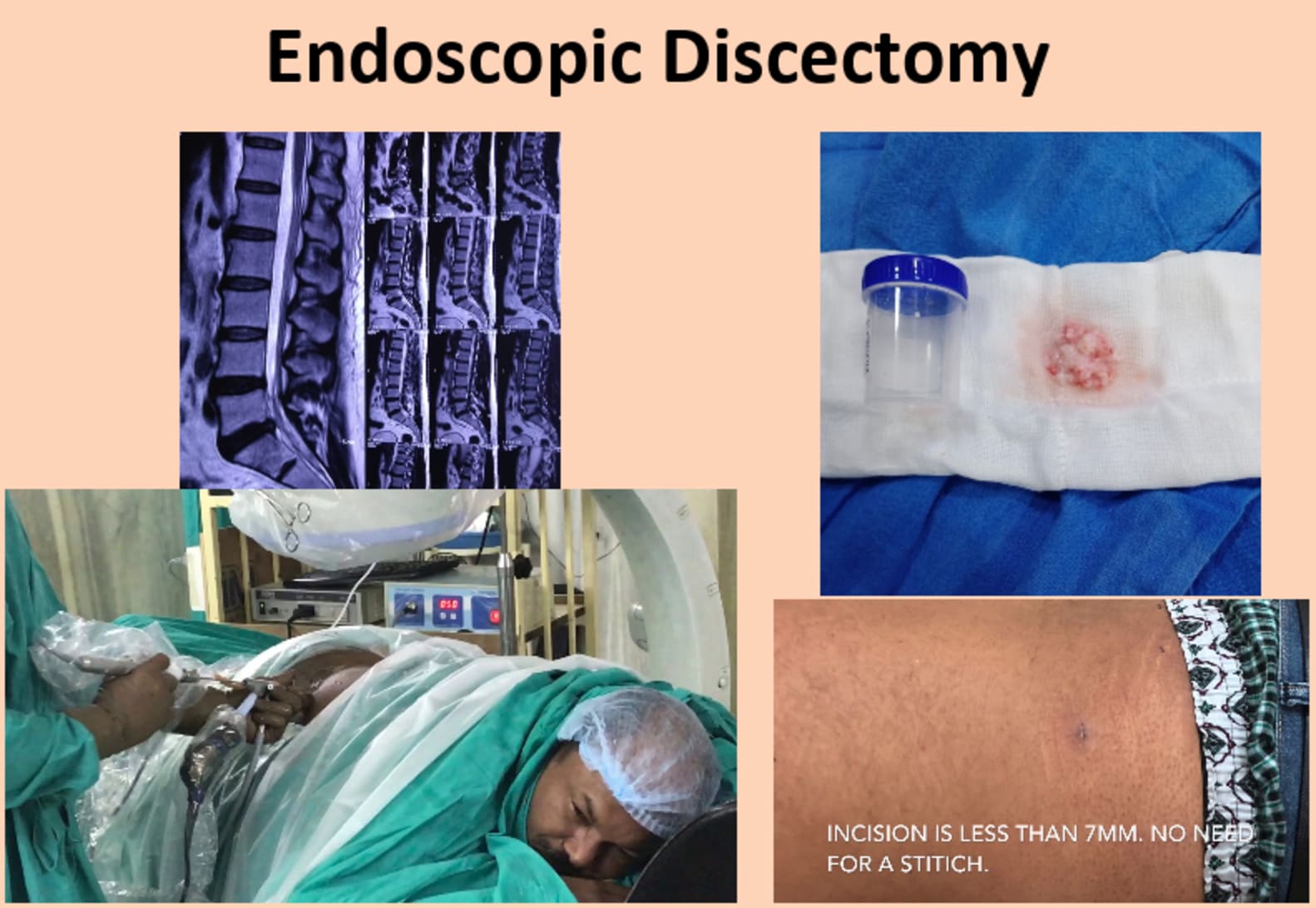 Endoscopic vs. Open Back Surgery