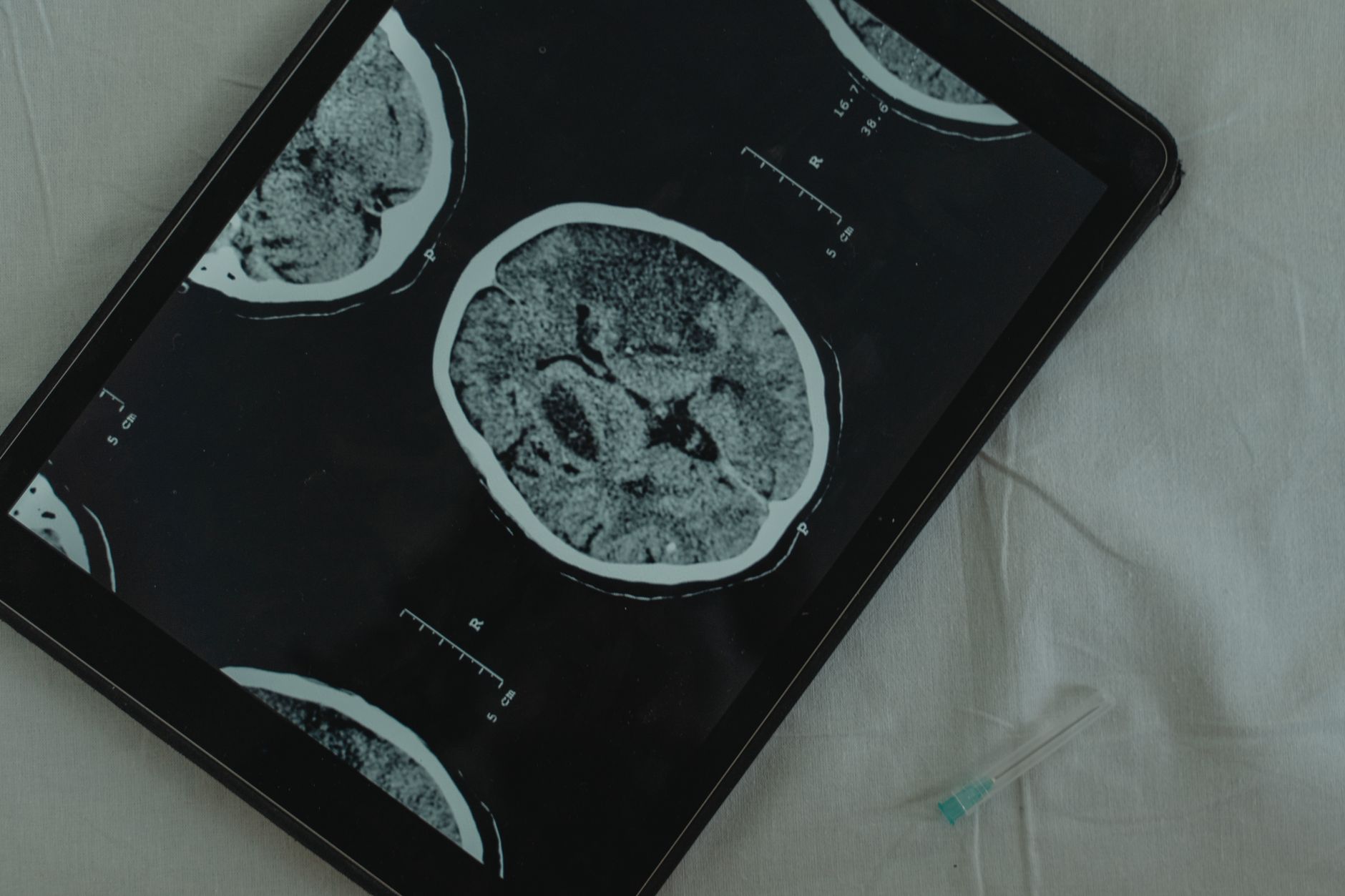 13-second eye test shows brain injury recovery progress