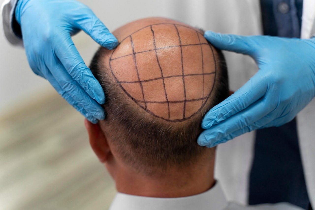 Hair Transplant- Types & Cost In India