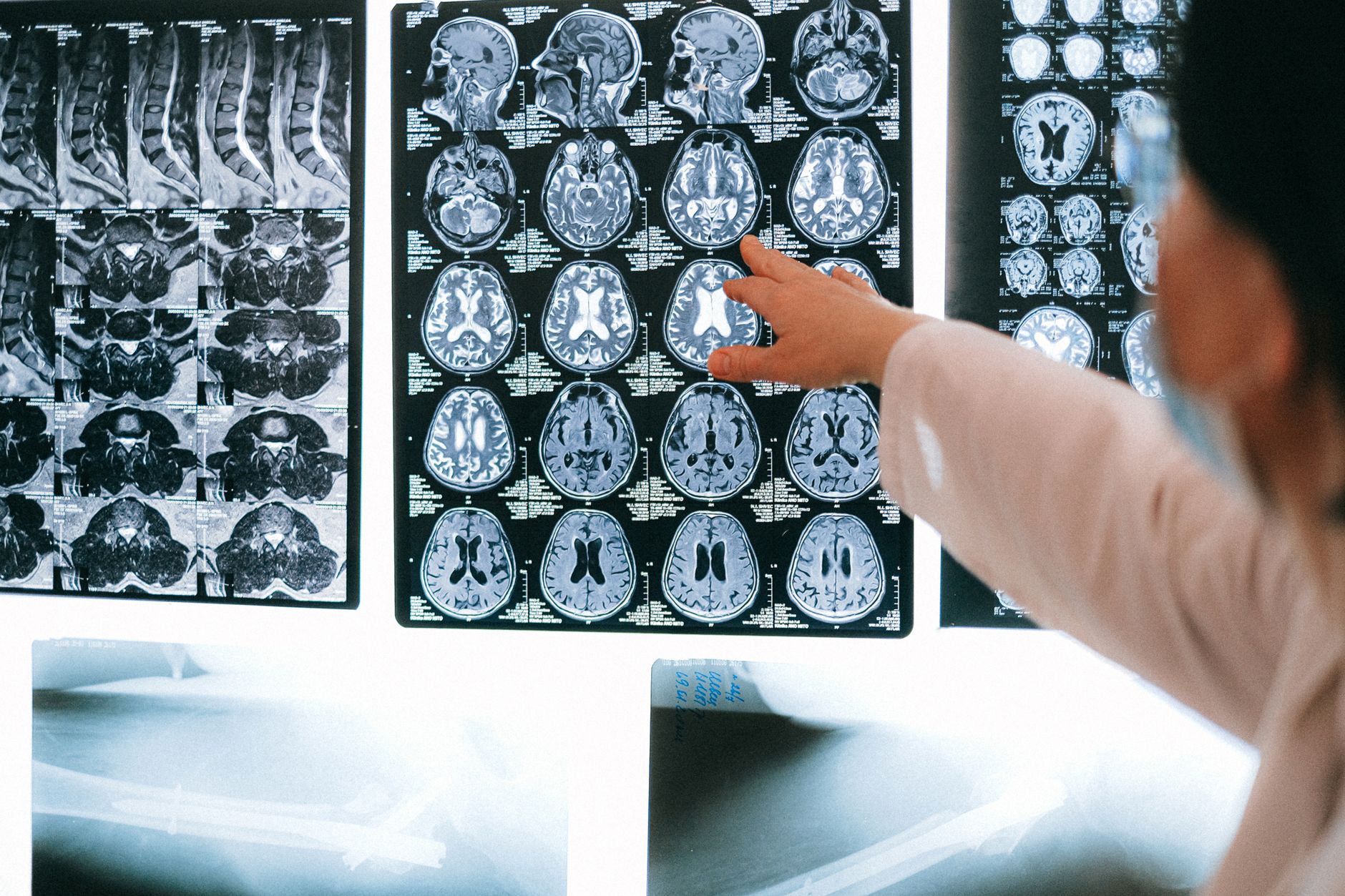 The impact of neurological disorders on a person’s quality of life