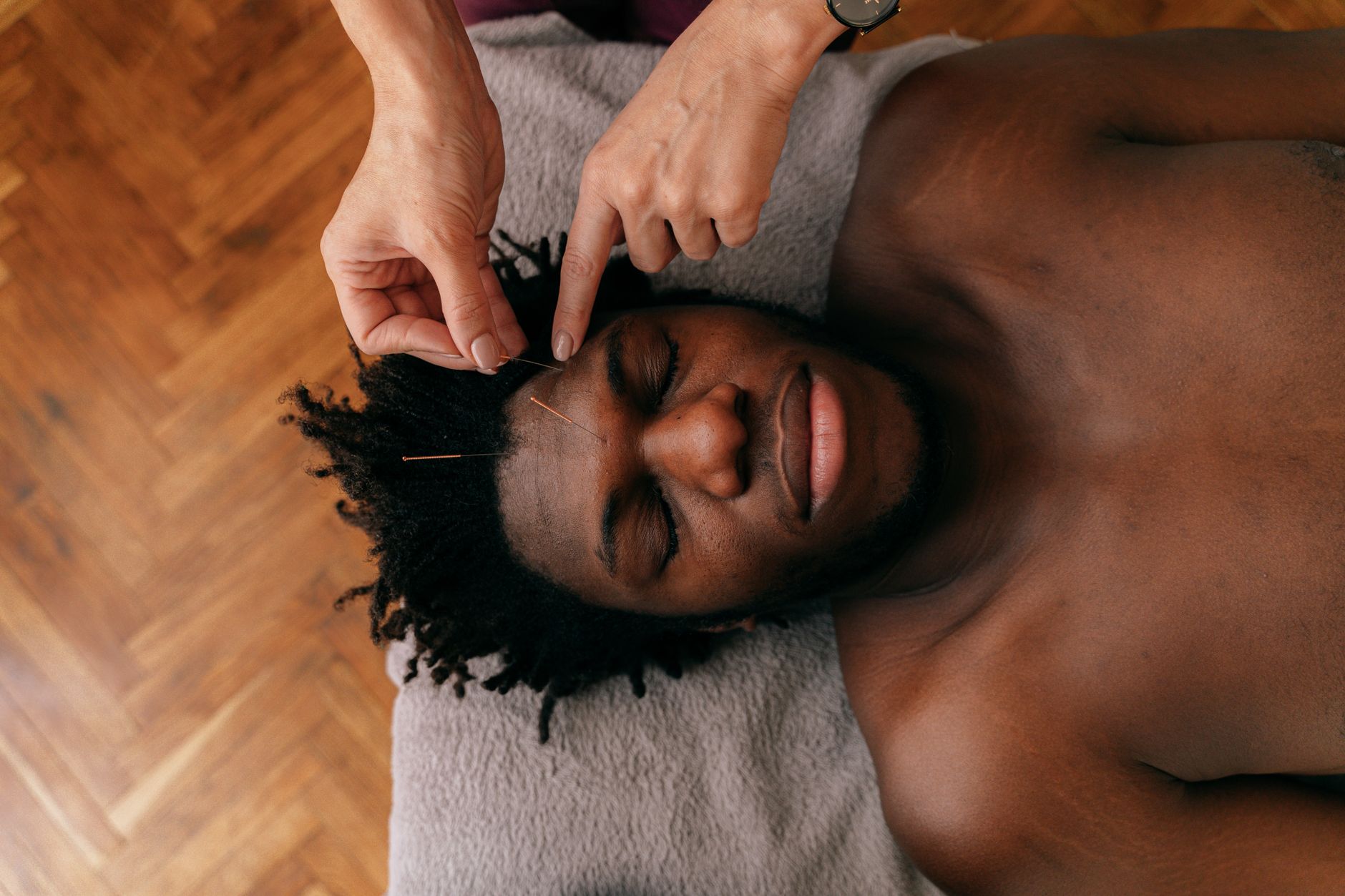 Acne – How to Cure it with Homeopathy and Acupuncture