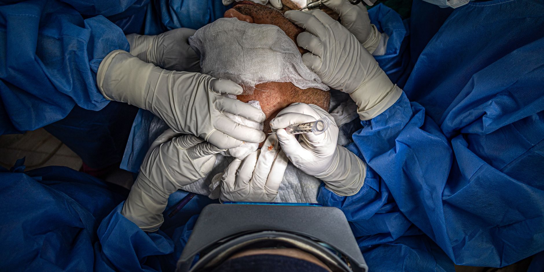 FUE vs. FUT: What Type Of Hair Transplant Is Best For You?