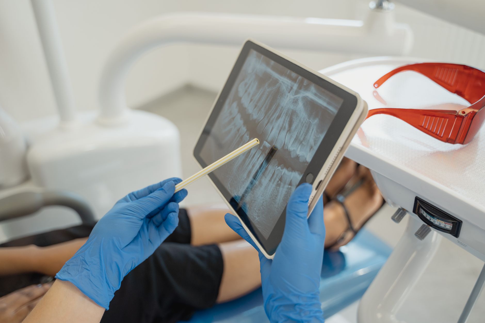 Impacted Wisdom Teeth Removal | Things To Know