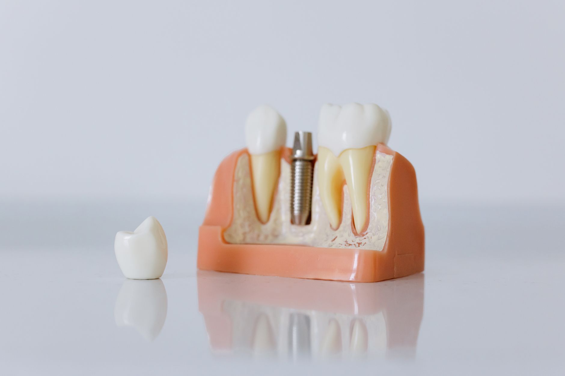 3 Things You Can Do To Ensure Your Dental Implant Treatment Is A Success