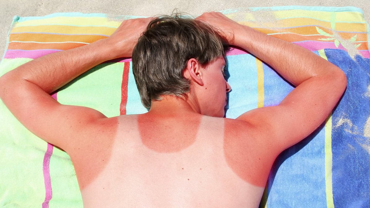 One bad sunburn can alter your life One bad sunburn can alter your life - sunburn risks