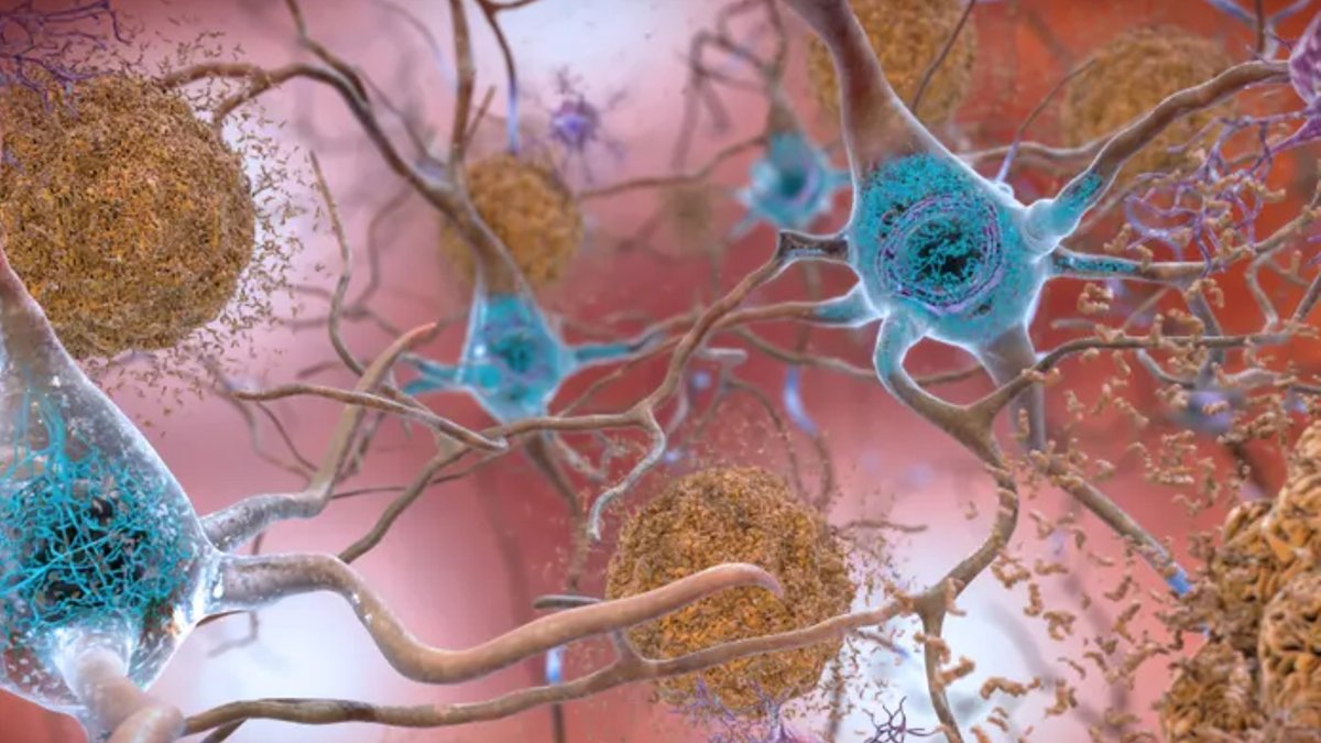 FDA approves new Roche and Lilly Alzheimer's tests FDA approves new Roche and Lilly Alzheimer's tests - alzheimer's tests