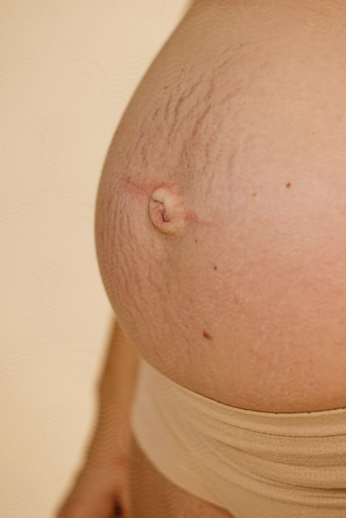 tommy of a pregnant woman with lots of stretch marks