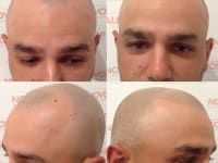 Scalp Micropigmentation Before And After Scalp Micropigmentation Before And After