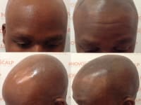Scalp Micropigmentation Before And After Scalp Micropigmentation Before And After
