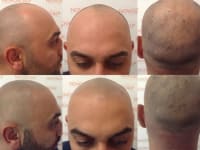 Scalp Micropigmentation Before And After Scalp Micropigmentation Before And After
