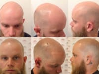 Scalp Micropigmentation Before And After Client 3