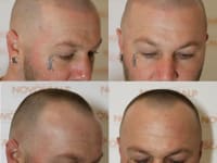 Scalp Micropigmentation Before And After Scalp Micropigmentation Before And After