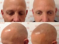 Scalp Micropigmentation Before And After Scalp Micropigmentation Before And After