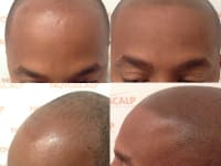 Scalp Micropigmentation Before And After Scalp Micropigmentation Before And After
