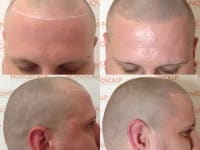 Scalp Micropigmentation Before And After Scalp Micropigmentation Before And After