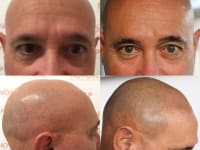 Scalp Micropigmentation Before And After Scalp Micropigmentation Before And After