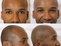 Scalp Micropigmentation Before And After Client 4