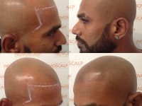 Scalp Micropigmentation Before And After Scalp Micropigmentation Before And After
