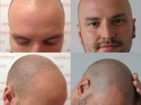 Scalp Micropigmentation Before And After Client 1