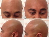 Scalp Micropigmentation Before And After Scalp Micropigmentation Before And After