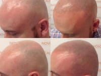 Scalp Micropigmentation Before And After Scalp Micropigmentation Before And After
