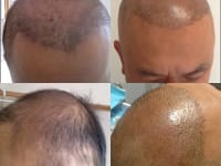 Scalp Micropigmentation Before And After Scalp Micropigmentation Before And After