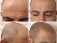 Scalp Micropigmentation Before And After Client 2