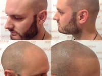 Scalp Micropigmentation Before And After Scalp Micropigmentation Before And After