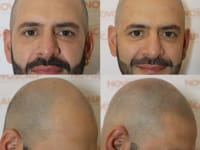 Scalp Micropigmentation Before And After Scalp Micropigmentation Before And After