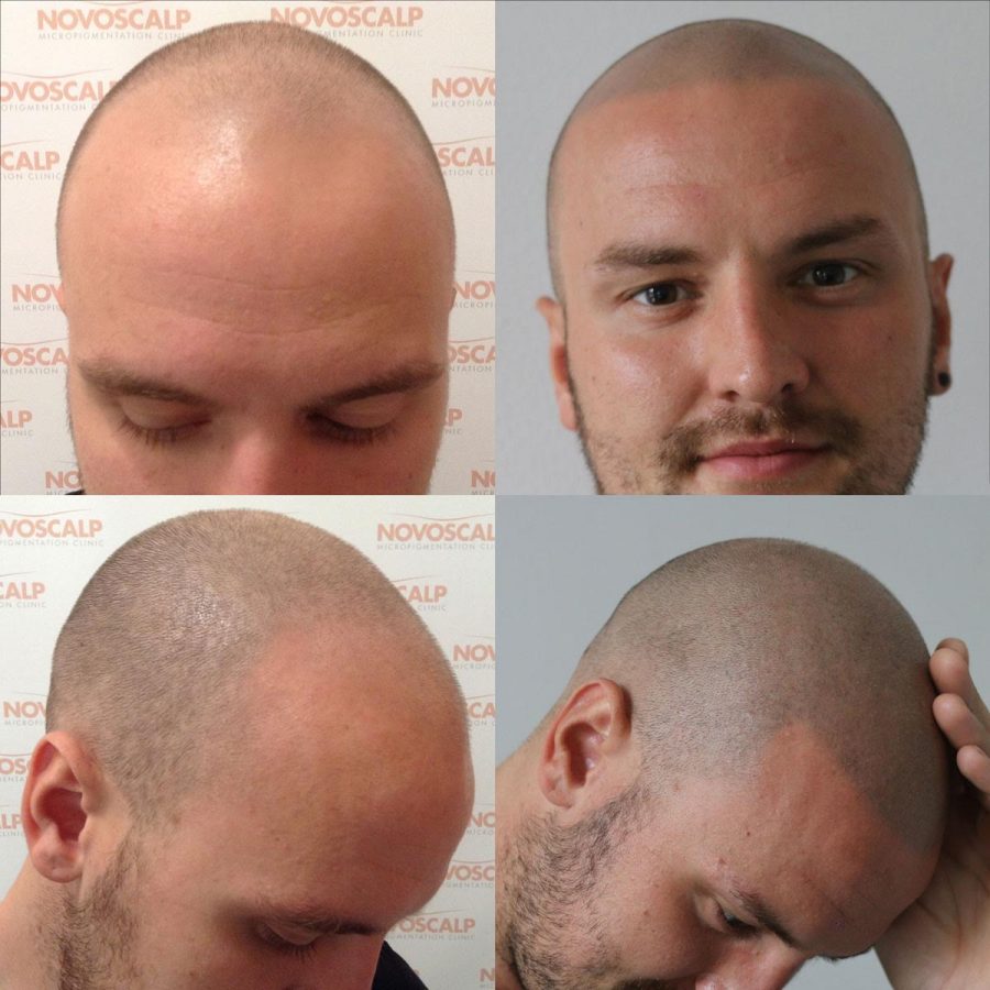 Scalp Micropigmentation Clinic Hair Tattoo Sydney Novoscalp