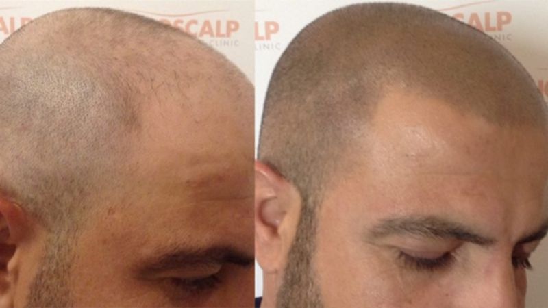 The Treatment for Male Pattern Baldness The Treatment for Male Pattern Bladness