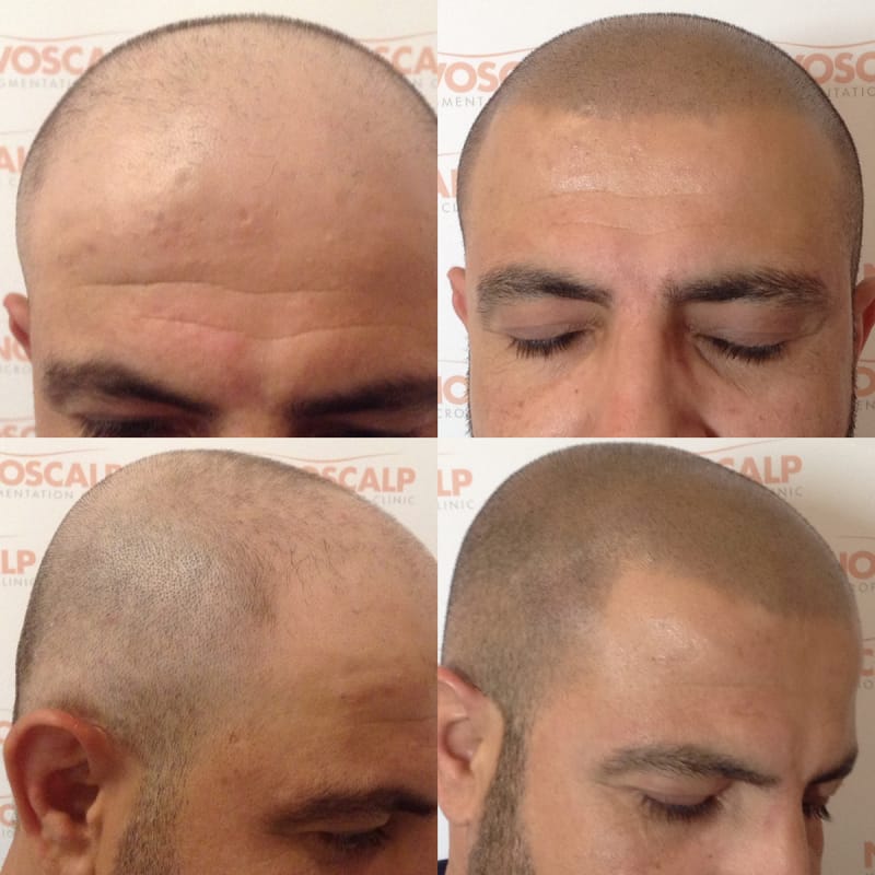 Scalp Micropigmentation Clinic Hair Tattoo Sydney Novoscalp scalp micropigmentation clinic hair