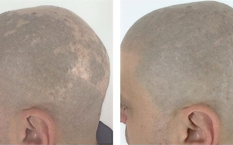 SMP Treatment for Alopecia Sufferers SMP Treatment for Alopecia Sufferers