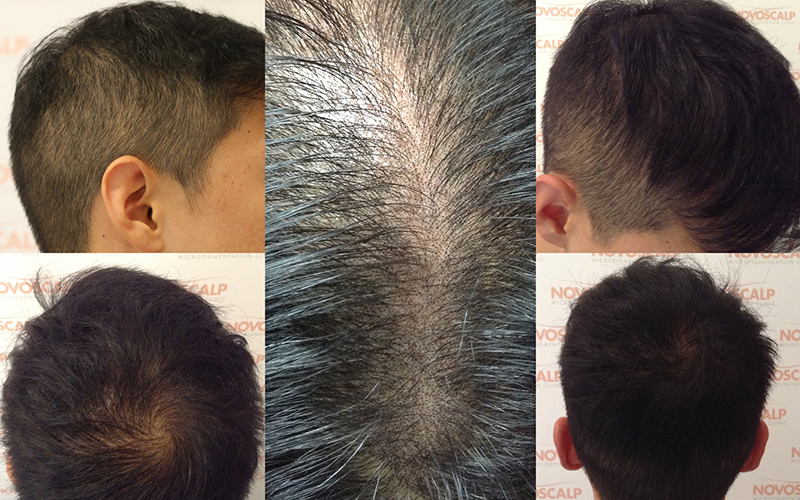 SMP Treatment for Hair Density Look SMP Treatment for Hair Density Look