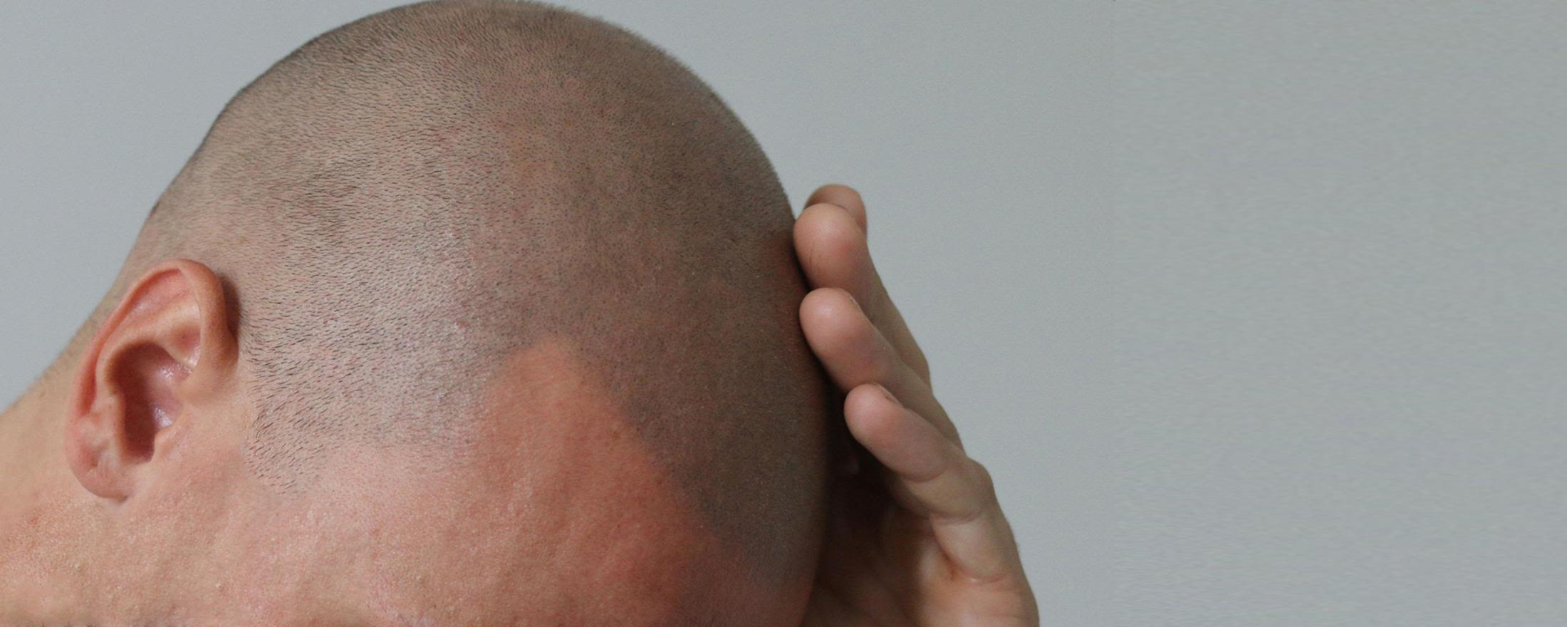 Scalp Micropigmentation Clinic Hair Tattoo Sydney Novoscalp