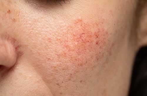 İnsan Cilt Mikrobiyomu