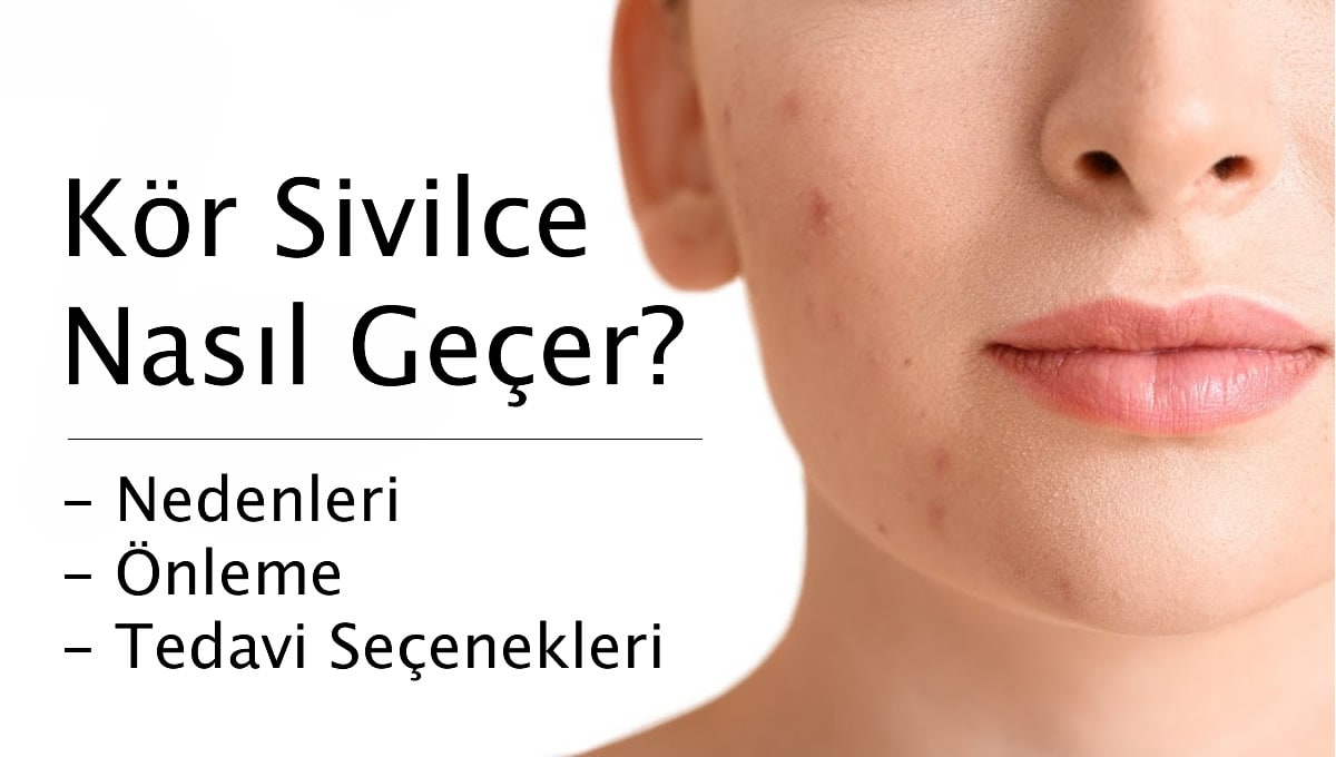 Kör Sivilce Nasıl Geçer?