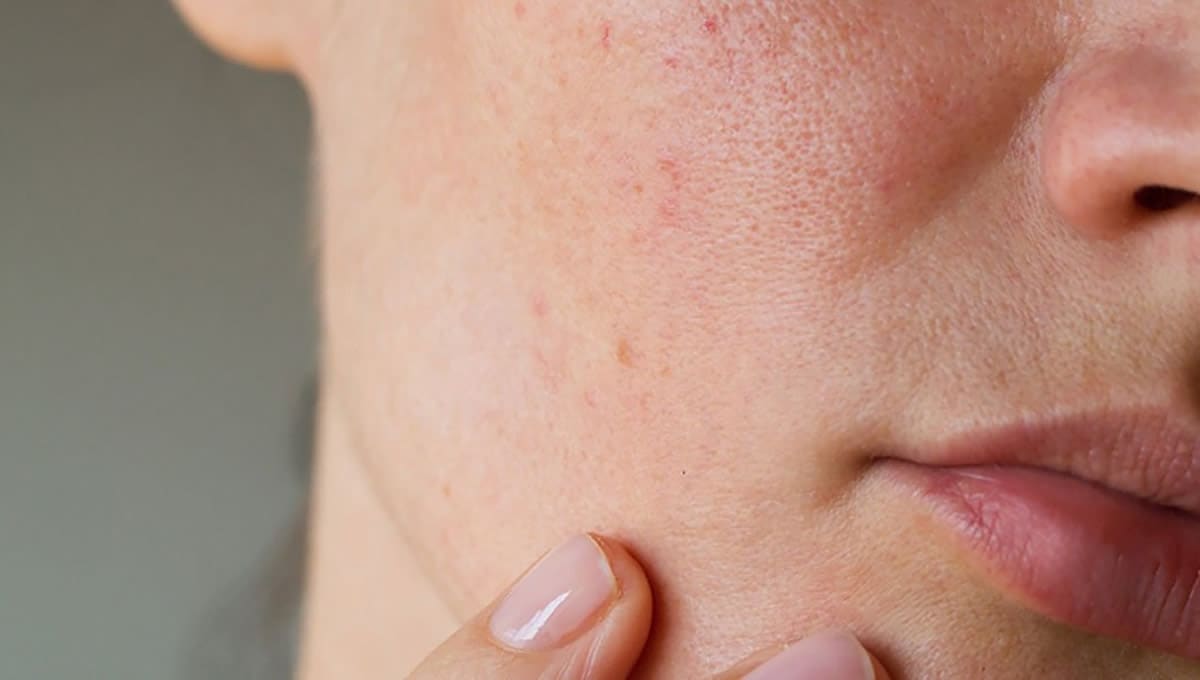 Rozasea için Güneş Kremi ve Nemlendirici Tavsiyesi