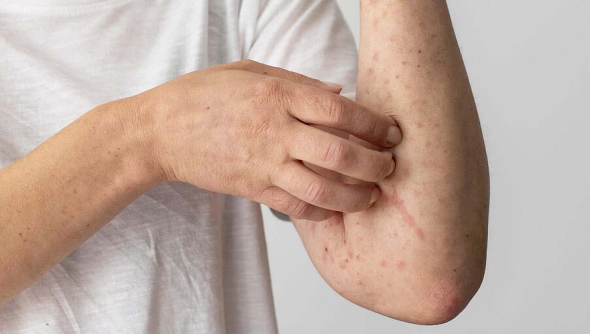 Güneş Alerjisi ve Güneş Koruyucu Seçimi