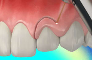 Crown-Lengthening-