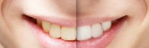 Teeth-Whitening-300x98