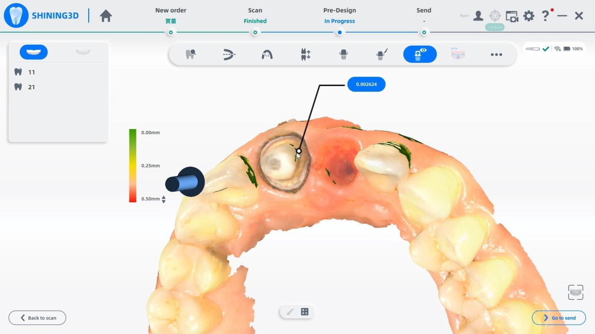 Things To Keep In Mind While Buying an Intraoral Scanner