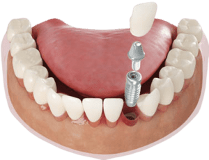 Teeth_with_implant-removebg-preview-300x230