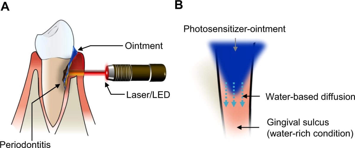 Photodynamic Therapy in Periodontics A New Frontier 1