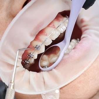ghost aligners