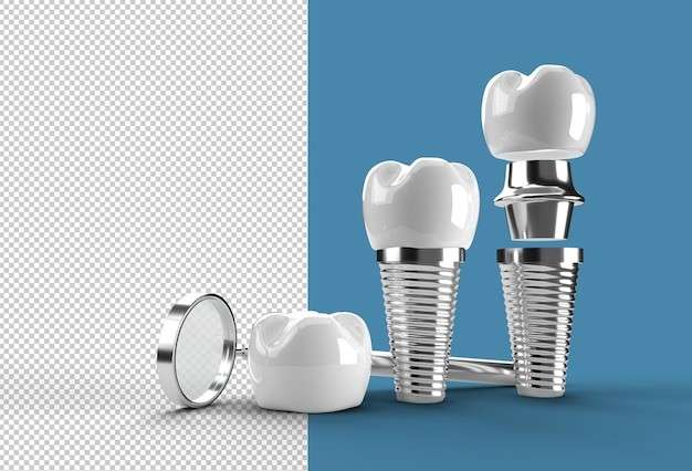 Revolutionizing Dental Care with Implant Technology
