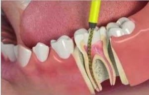 Endomotor- A boon in Endodontics