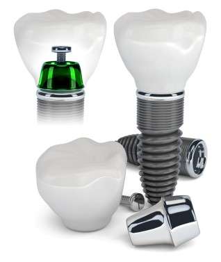 Advancements in Dental Implant Technology