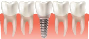 Robot-Assisted Implant Surgery: Advancements and Considerations